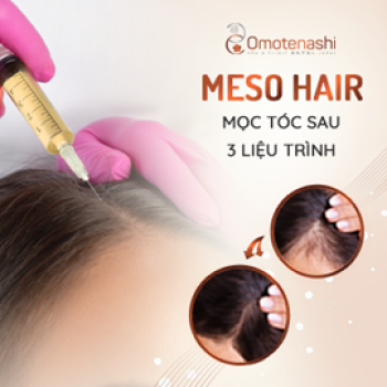 Liệu pháp meso hair trong điều trị rụng tóc