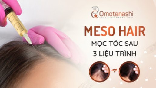 MESO HAIR - TẠM BIỆT NỖI LO TÓC RỤNG, TÓC THƯA